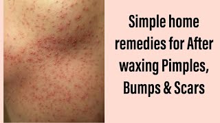 DIY for After wax Pimples and bumps