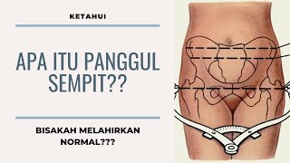 APA ITU PANGGUL SEMPIT?