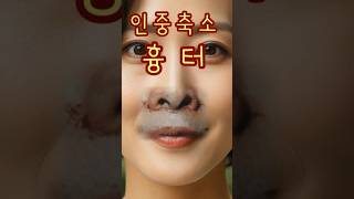 코밑절개 흉터, 입술 입꼬리 흉터가 없는 무흉인중축소