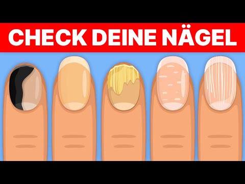 Video: Warum sieht Lunula weißlich aus?