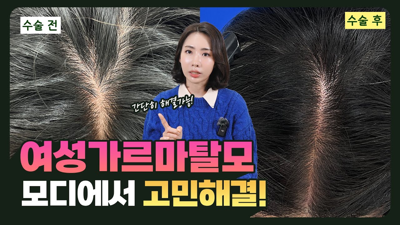 가르마가 넓어지는 여성분들 주목 — 여성형 탈모 극복법