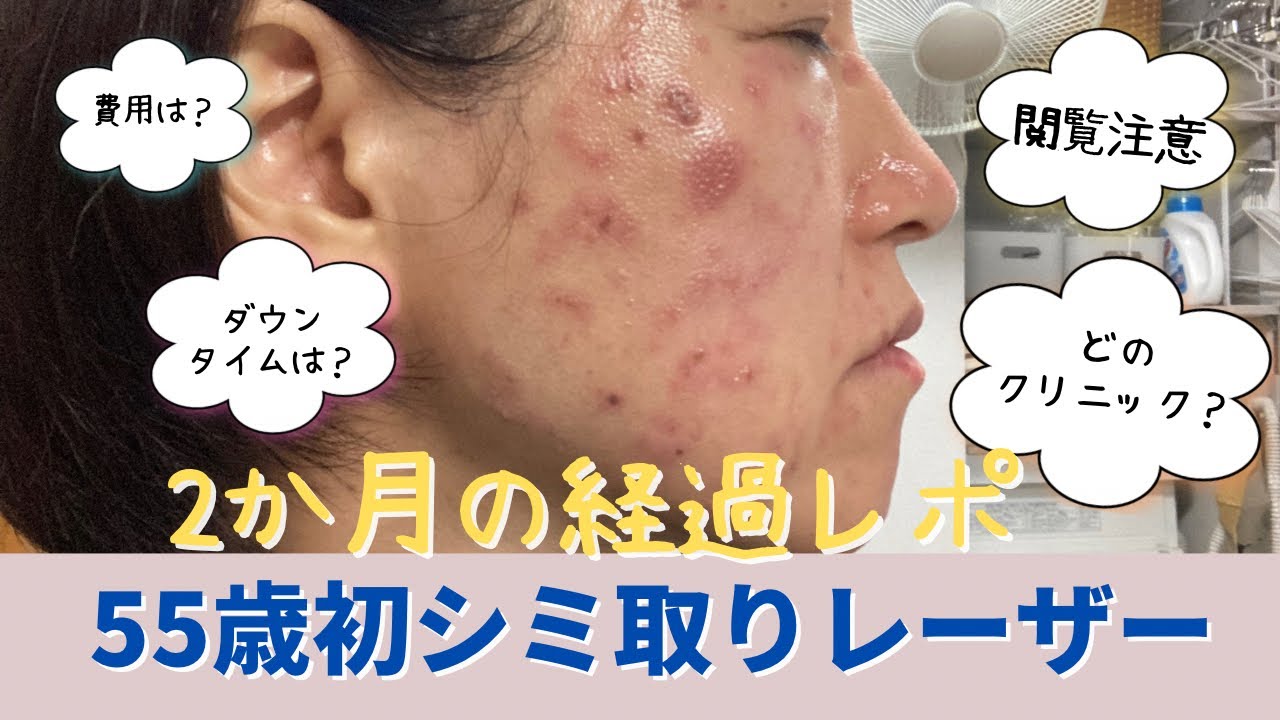 【シミ取り】55歳が初ピコレーザーシミ取り体験記ダウンタイムお知らせ