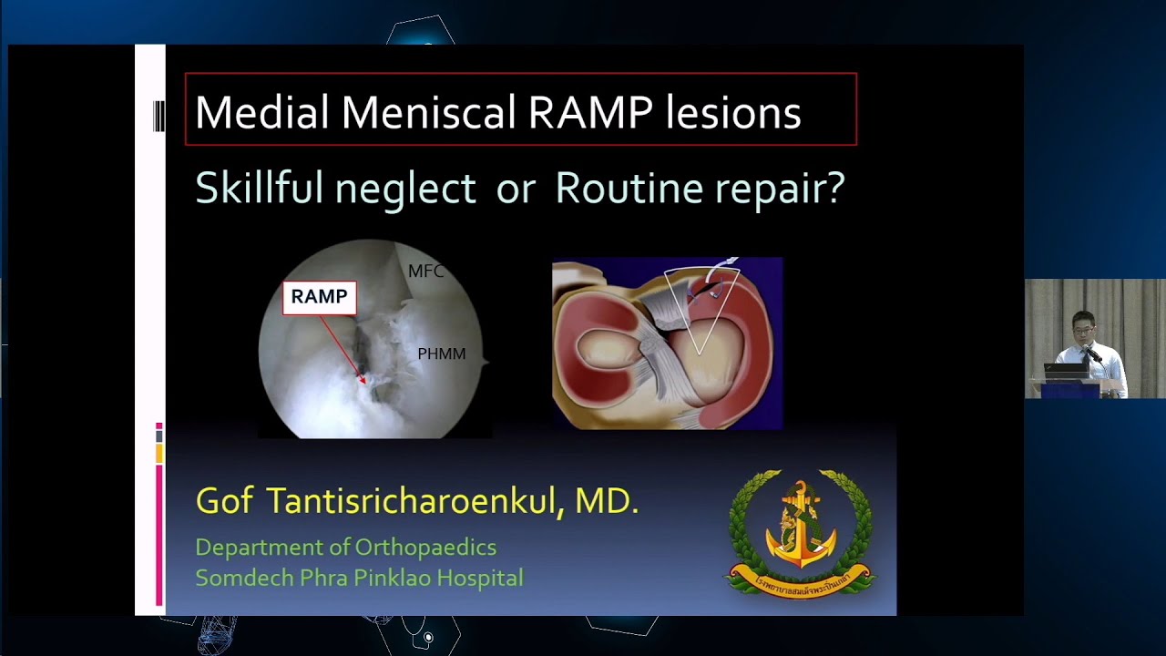 Meniscal ramp lesions skillful Neglect or Routine repair YouTube
