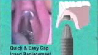 Flexi-Overdenture Placement