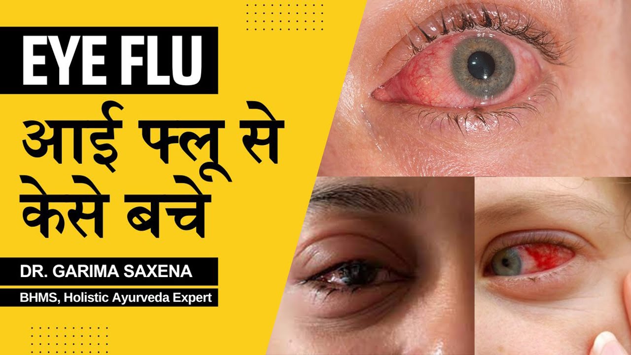 Eye Flu Ayurvedic Remedies TimeTested Ayurvedic Eye Care Techniques