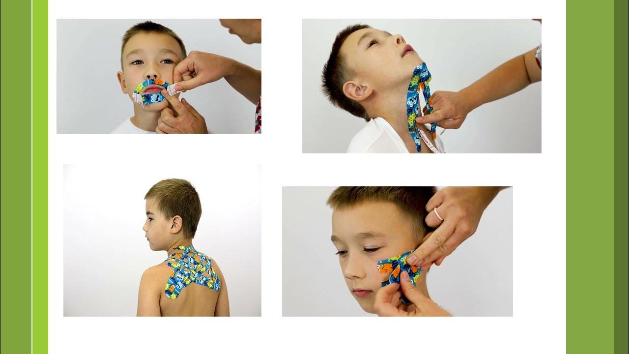 тейпы для детей логопедия. тейпирование детей схемы. тейпирование детей. тейпирование в логопедии. кинезио тейп схемы.