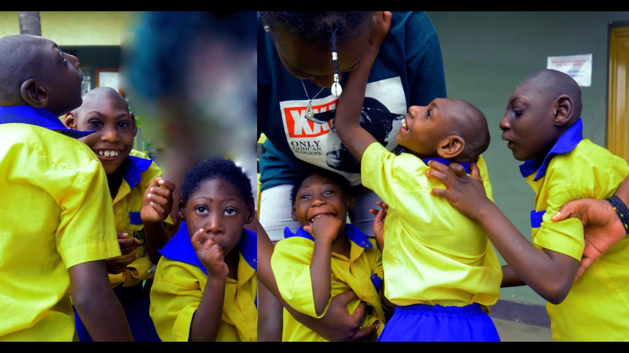 Ba bana bavukanye amasura adasanzwe bakabita inkende ubuzima bwabo bwarahindutse ||byadutangaje