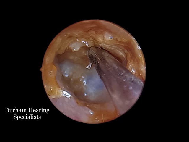 Earwax soup created by sodium bicarb drops suctioned off eardrum class=