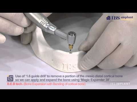 [B.E.B Technique] Bone Expansion with Bending of corticcal bone(Hands-on Protocol) - IBS Implant