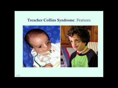 Treacher Collins Syndrome - CRASH! Medical Review Series