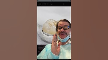 Gold and Porcelain Dental Crown Information