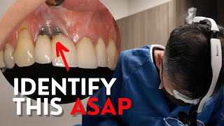 All on Four Early Dental Implant Failure by North Texas Dental Surgery 10,022 views 5 months ago 41 minutes