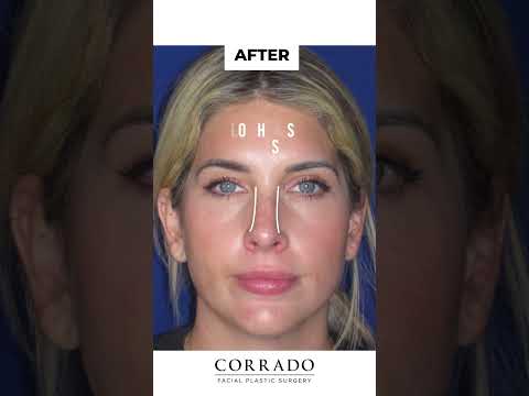 Video thumbnail: Nose Job Before and After Pictures: Dorsal Hump, Droopy Top | Dr. Anthony Corrado · Dr. Anthony Corrado