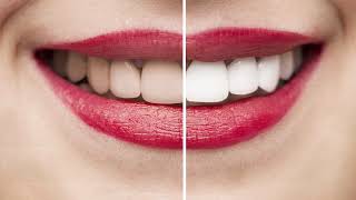 Celebrity FAQ - What is the difference between whitening in office versus at home? | Sierra Smiles Wealth
