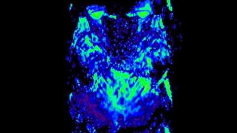 Disseminated Choroid Plexus Papilloma