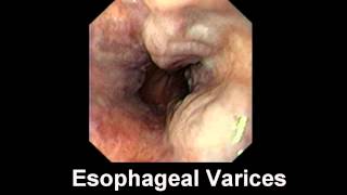 Hepatitis C: An Overview