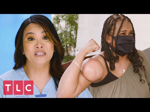 Woman Has a Huge Lipoma Growing Out of Her Arm | Dr. Pimple Popper
