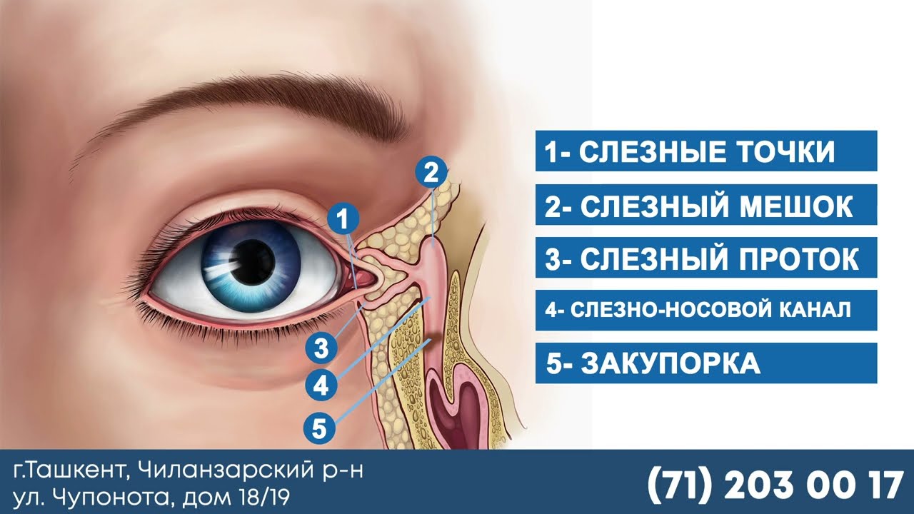 Ку'з шомоллаши: Туг'ма ку'з еш каналинг беркилиб колиши — белгилари, асоратлари ва даволаш! ЧИЛАНЗАР