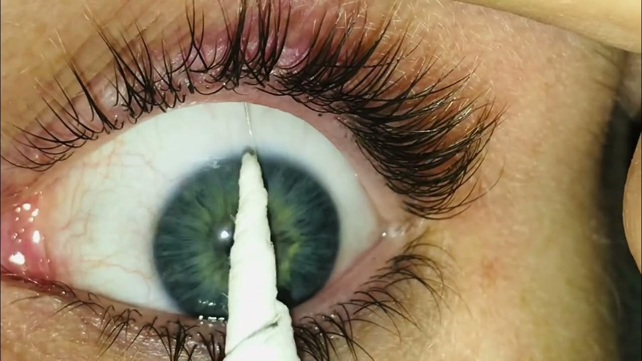 Eye mucous fishing syndrome YouTube