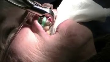 Physics Forceps Extraction of Upper Right Lateral Incisor from GoldenDent, Atraumatic Extraction