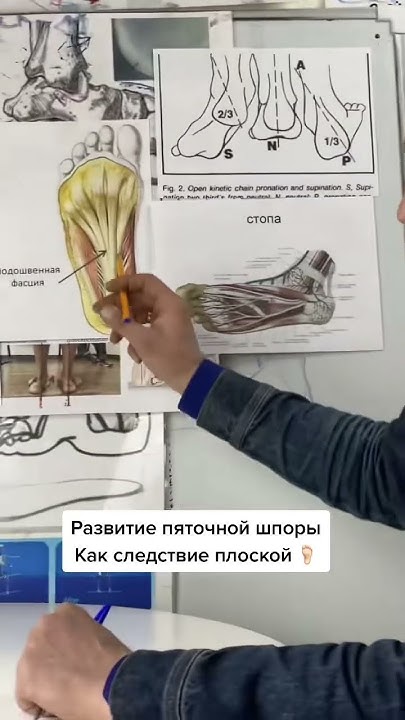 Развитие пяточной шпоры 🫤 #пяточнаяшпора #плоскостопие #стельки # ...
