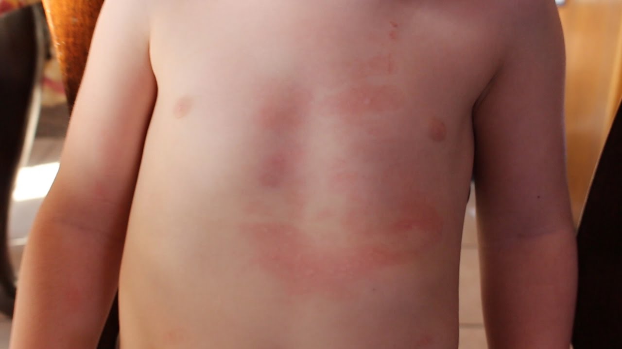 Sick Toddler Gets Rash YouTube