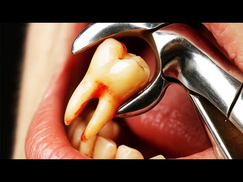 Tooth Extraction Explained (3D Animation)