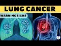 Lung Cancer Warning Signs II Lung Cancer Symptoms