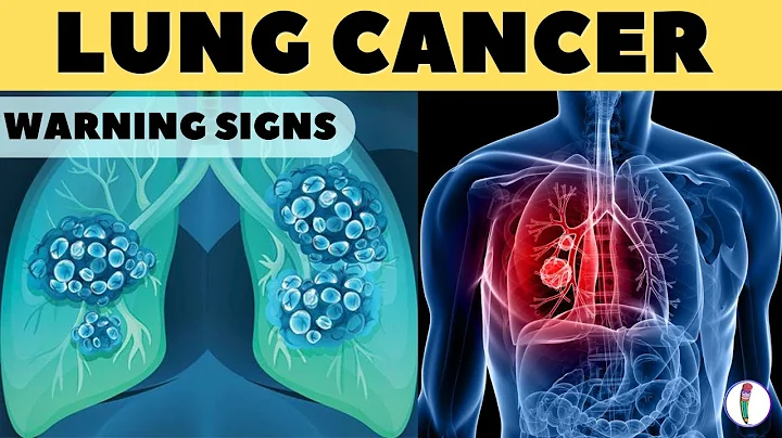 Lung Cancer Warning Signs II Lung Cancer Symptoms - DayDayNews