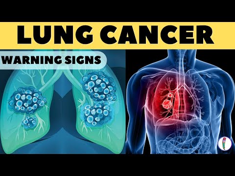 Lung Cancer Warning Signs II Lung Cancer Symptoms