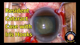resident cataract surgery case using iris hooks for a small pupil