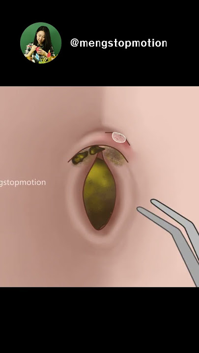 ASMR Oddly Satisfying Remove Huge Navel Stone | Navel cleaning | piercing removal #animation