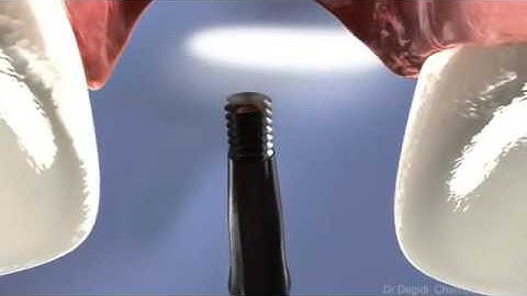 An incredible journey - The Chamber Concept of Dr. Marco Degidi