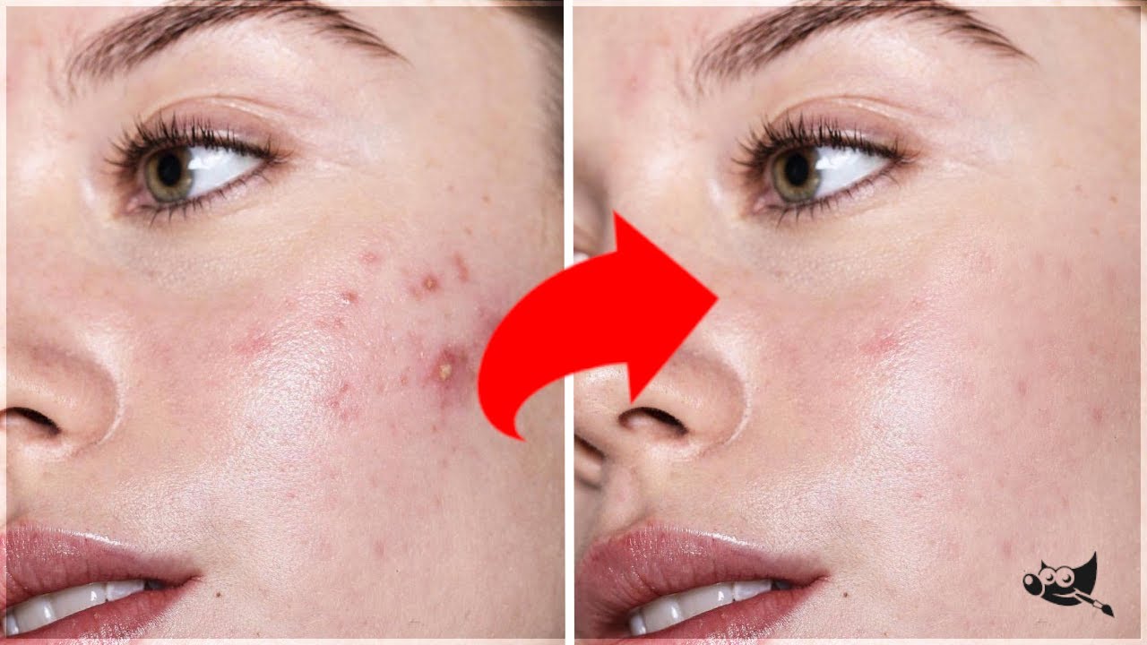 2 Formas de Tirar Espinhas no GIMP