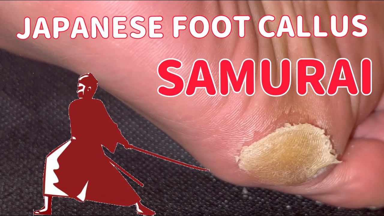 Satisfying Thick foot callus removal by Japanese Samurai YouTube