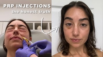 I Tried PRP Under Eye Injections so you don