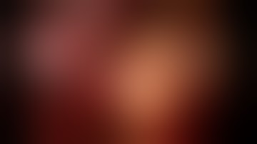 Uniportal VATS bilobectomy RUL + RML with huge bleeding control   part 1