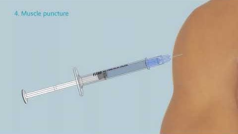 SKIFA Auto Disable/Destruct Syringe with Needle 0.5 ml
