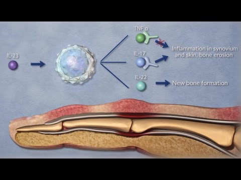 Psoriatic Arthritis - 3D Medical Animation