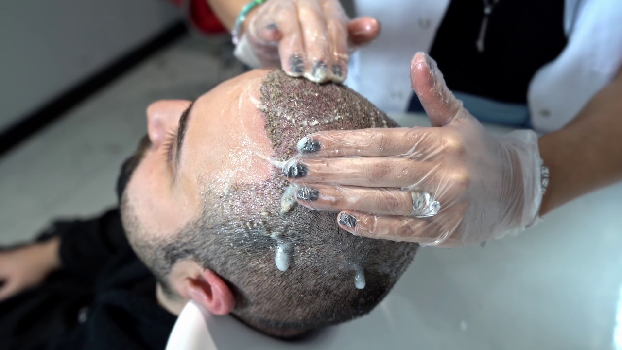 Мытье на 10-й день после пересадки волос