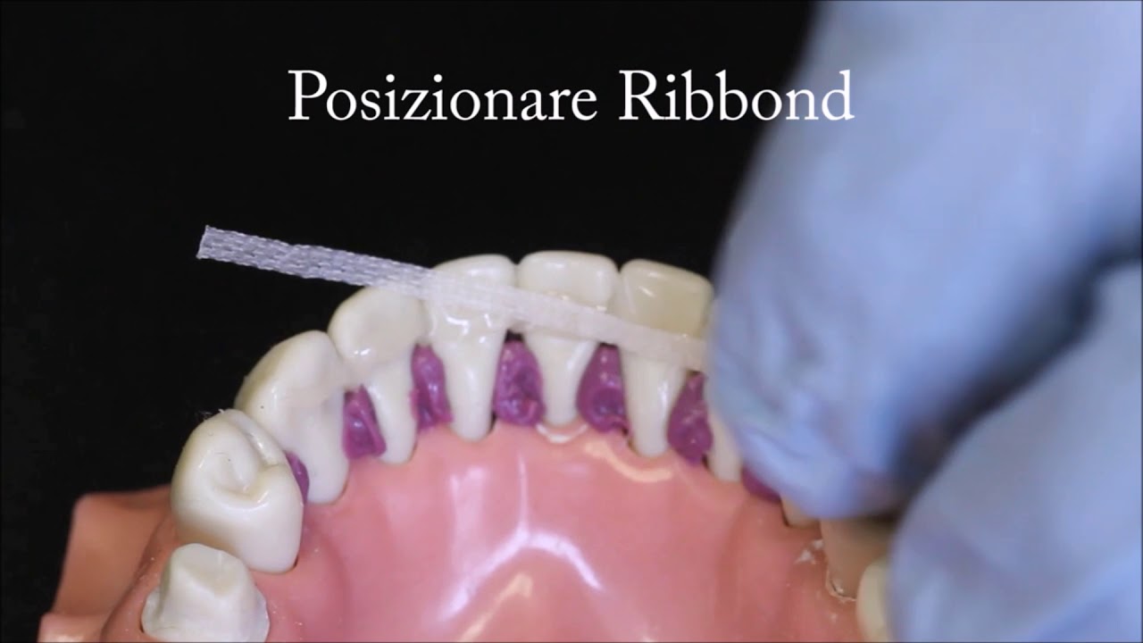 Ribbond Periodontal Splinting  italian audio