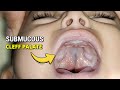 What is the Submucous Cleft Palate ? | Dr Parit Ladani.