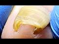 The Oversized Ingrown Toenail Is Stuck In The Toe, So It Needs To Be Trimmed【Xue Yidao】