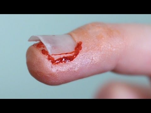 broken-fingernail!