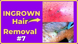 Ingrown hair removal videos [Compilations #7] #RemovalHair #ingrownhair #내성발톱  #ingrownhairShorts