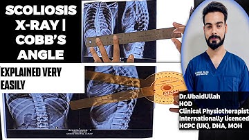 How to Measure Cobb’s Angle on X-Ray | Explained Simply