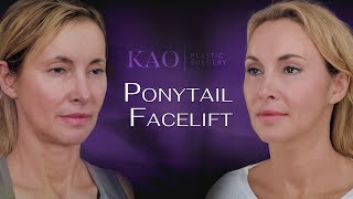 Ponytail Facelift Before & After - 3 Years Later - It Gets Better With Time?