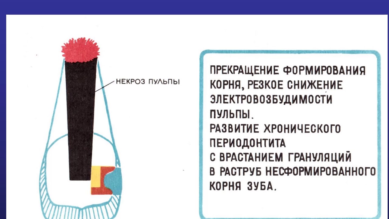 Пульпит постоянных зубов с несформированными корнями