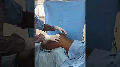É possível retirar silicone industrial do corpo?