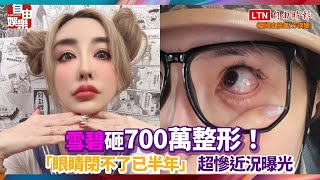 雪碧砸700萬整形！「眼睛閉不了已半年」 超慘近況曝光- 自由電子報影音頻道
